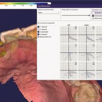 MetiSmile-MR mandibular trajectory tracking